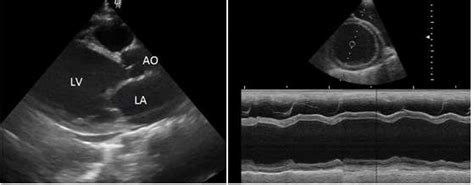 lv cavity is dilated